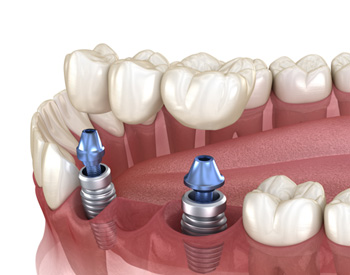 Illustration of implant bridge
