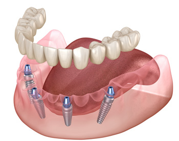 Illustration of implant denture
