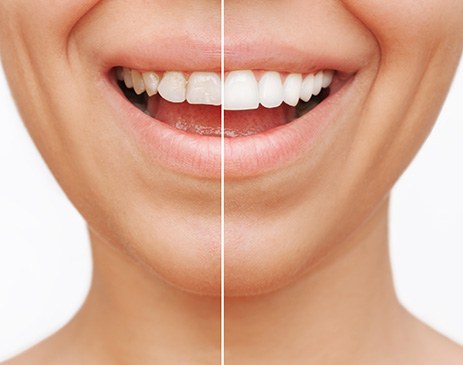 Patient's smile before and after veneers