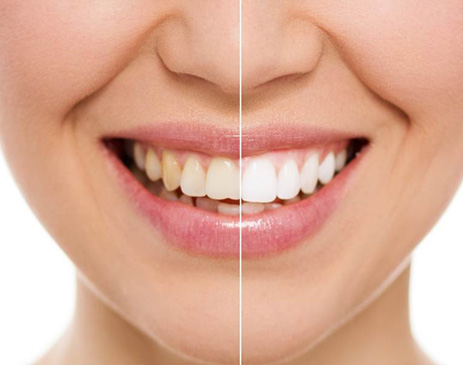 Close-up of white teeth after stain removal 
