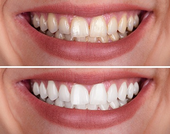 A woman’s smile before and after teeth whitening