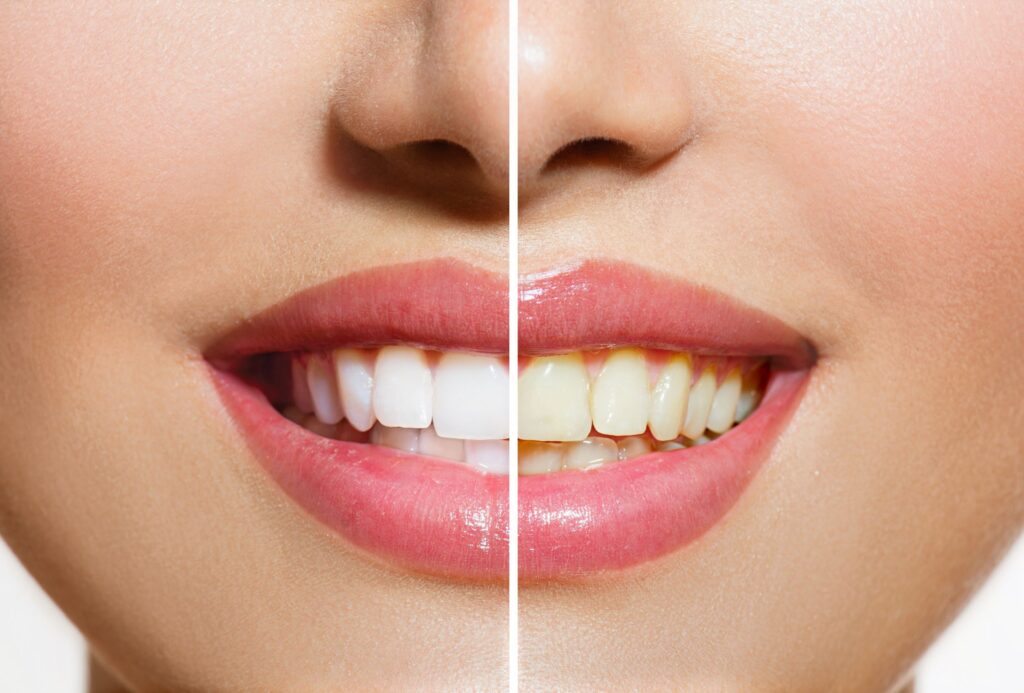 Nose-to-chin closeup of smile that's halved to show before/after results of teeth whitening