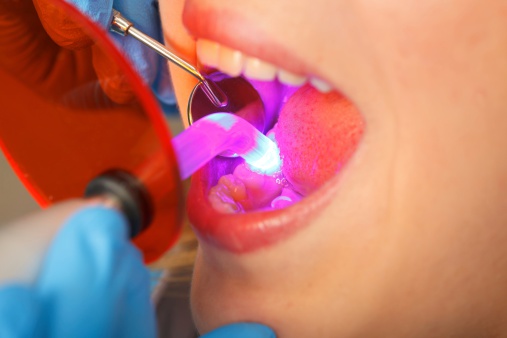 Dentist examining the mouth of a patient before creating dental bonds.