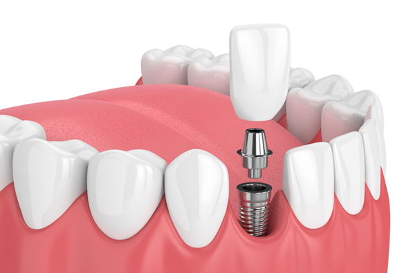Rendering of jaw with dental implant at Harper Dental in Fort Smith, AR