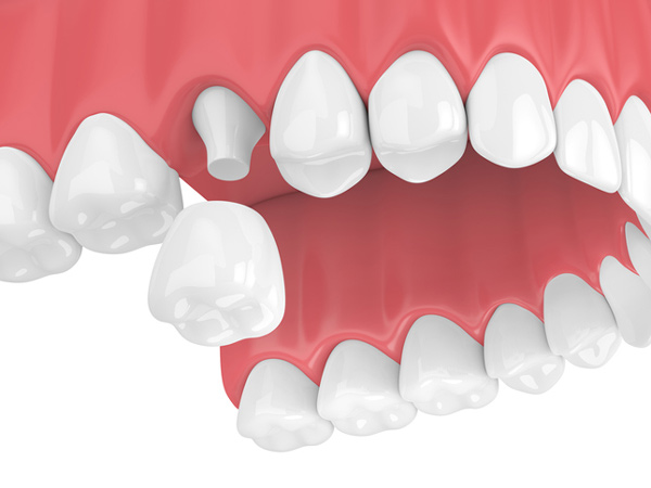 Rendering of jaw with porcelain dental crown at Harper Dental in Fort Smith, AR