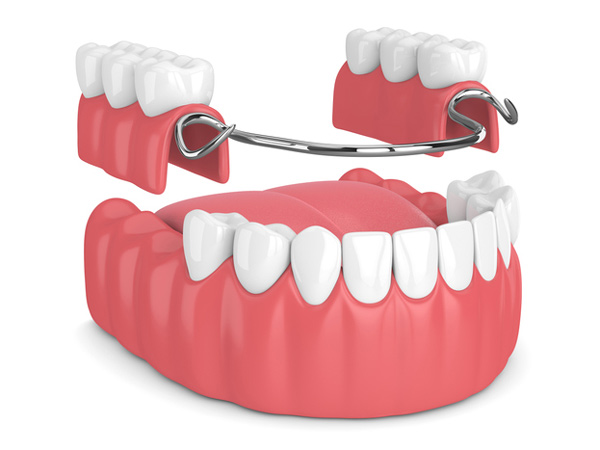 Rendering of removable partial denture.