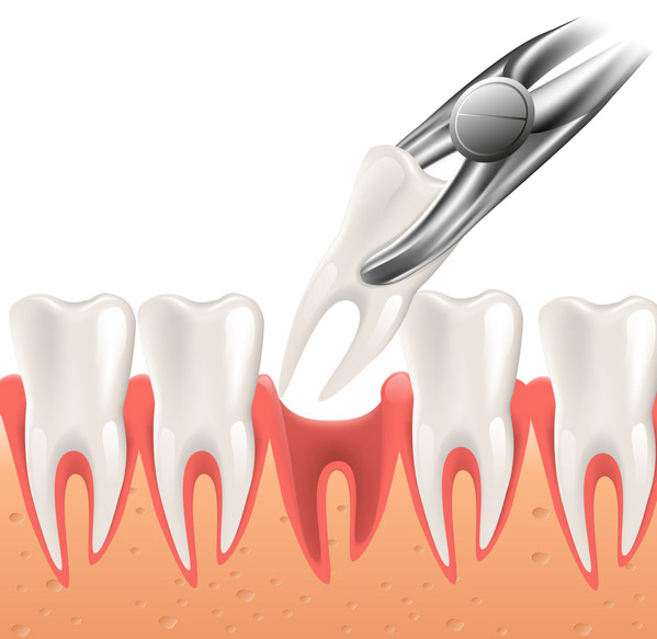 Illustration of a tooth being extracted.